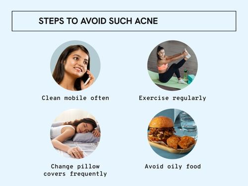 Be Bodywise Head-to-Toe Acne Clear Kit