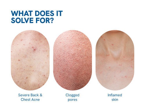 Be Bodywise 2.5% Benzoyl Peroxide Bodywash
