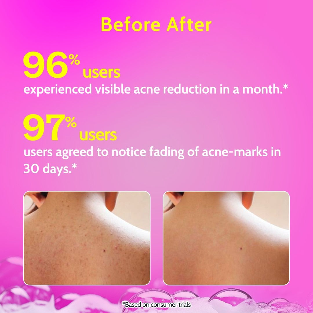Chemist at Play 1% Salicylic Acid Acne Control Body Wash - 473 ml