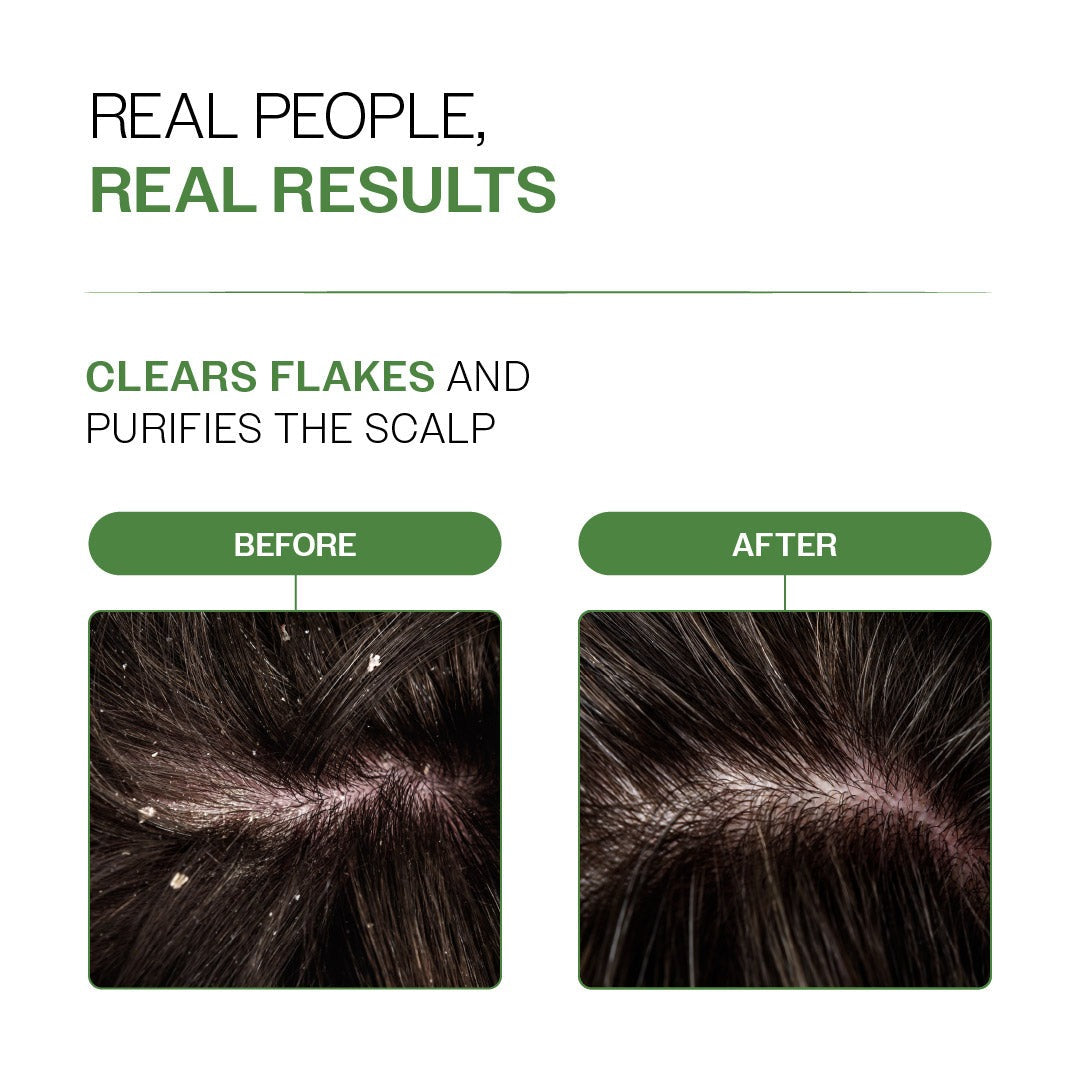 Bare Anatomy Neem & Lemon Dandruff Control Scalp Spray - 200 ml