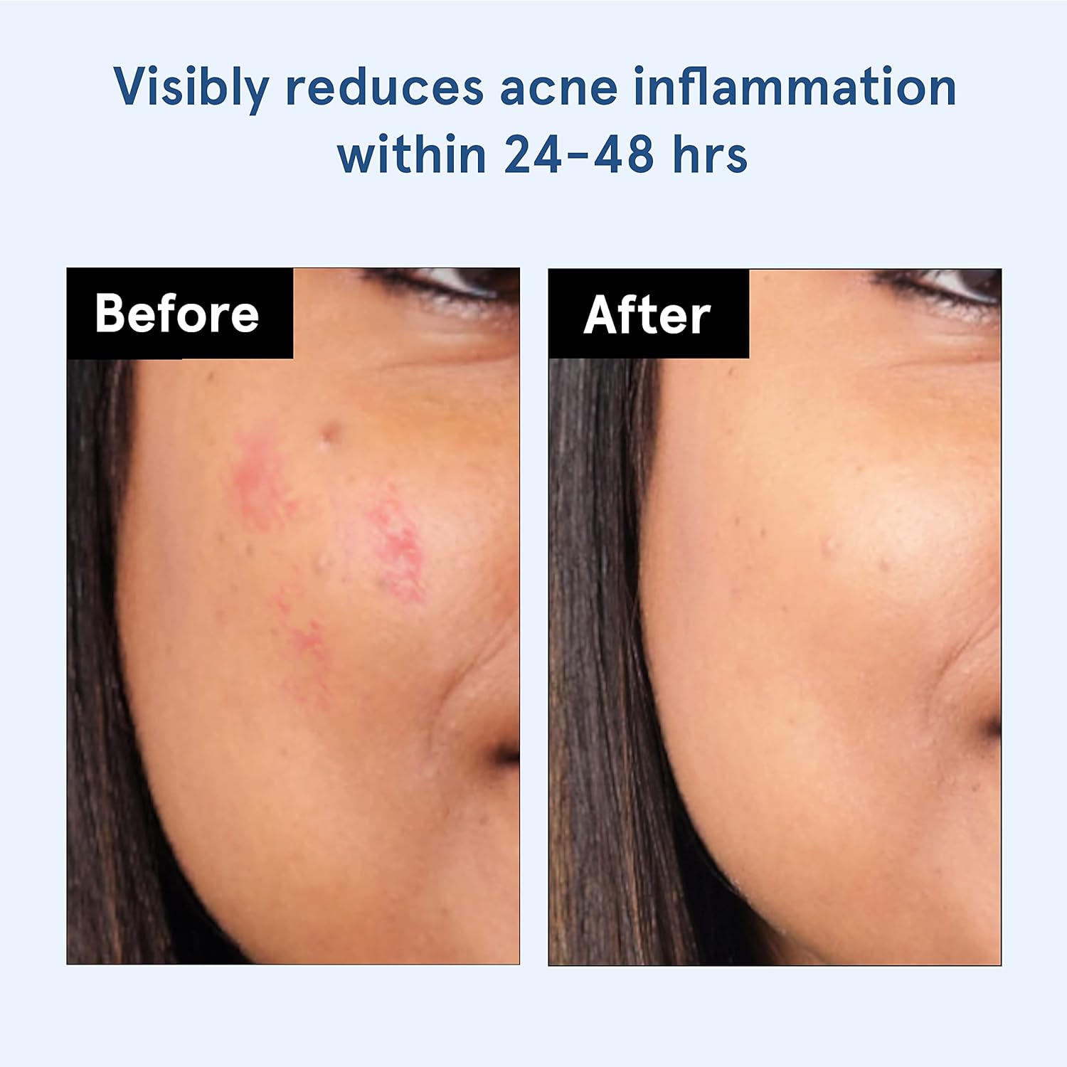 Be Bodywise Acne Pimple Patch