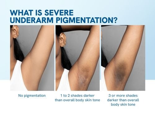 Be Bodywise Underarm Pigmentation Kit - No Fragrance