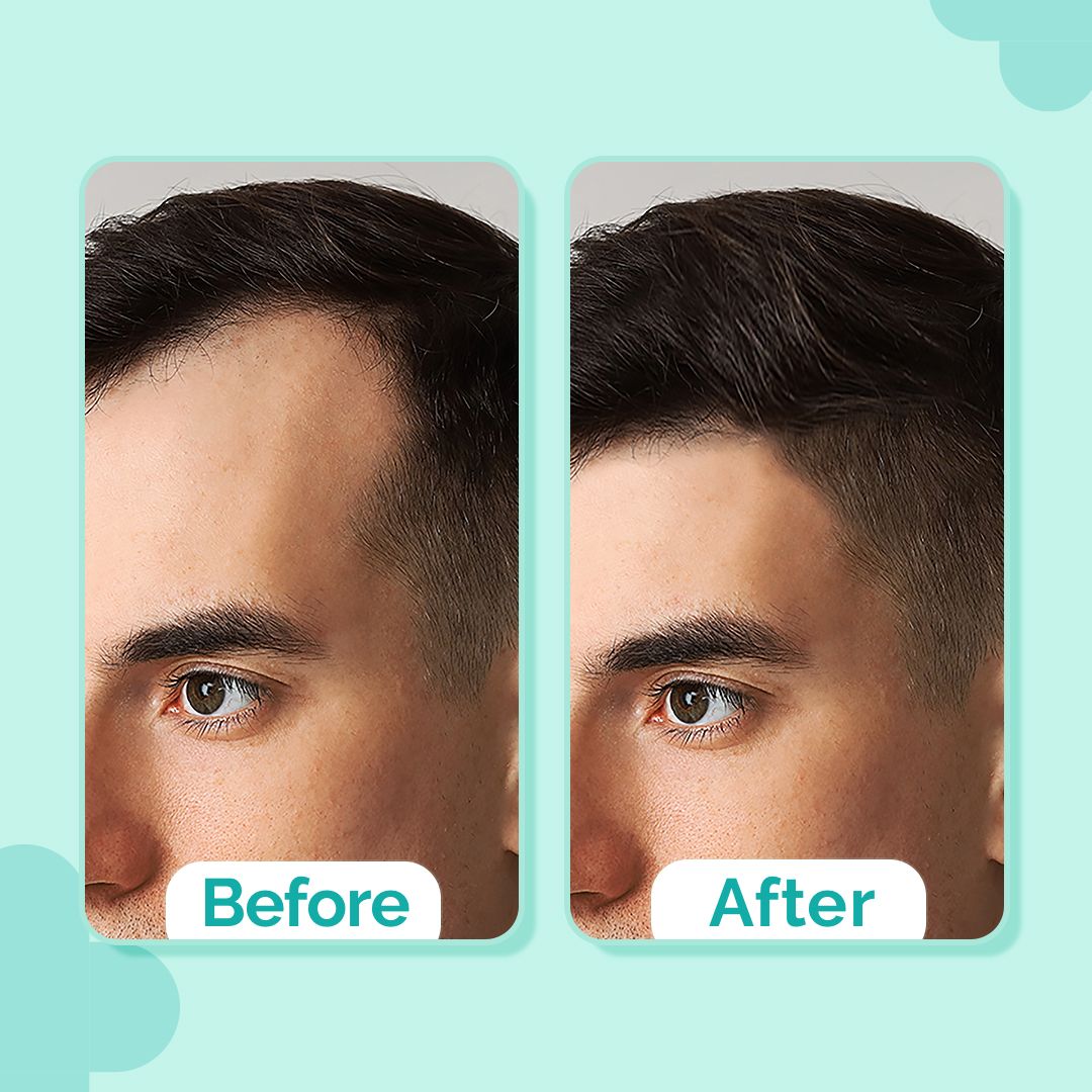 Derma Co 20% Actives Peptide-Stem Cell Hair Growth Serum with Foligen Analupe & Anagain For Hair Growth - 30ml