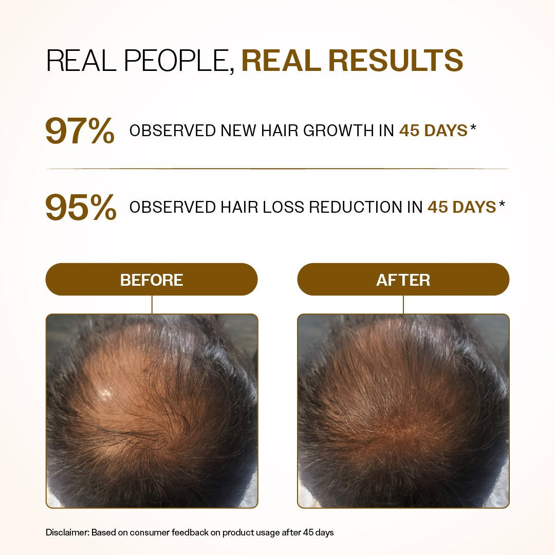 Bare Anatomy Advanced Hair Growth Serum Roll-On with Redensyl, Rosemary & Rice Water- 25 ml