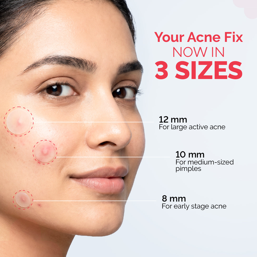 Derma Co 2% Sali-Cinamide Hydrocolloid Acne Patches - 36 Patches