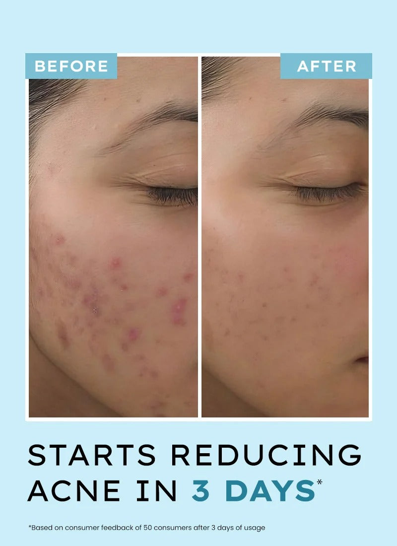 Hyphen Acne Defence Daily Serum - 30ml